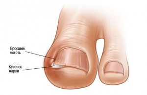 7 методов лечения вросших ногтей